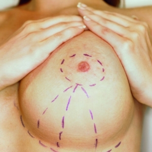 Уменьшение груди, маммопластика